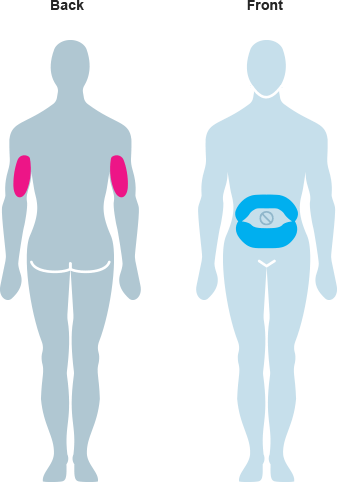 Points of the body where SUSTOL can be injected, which are the upper arm or your abdomen